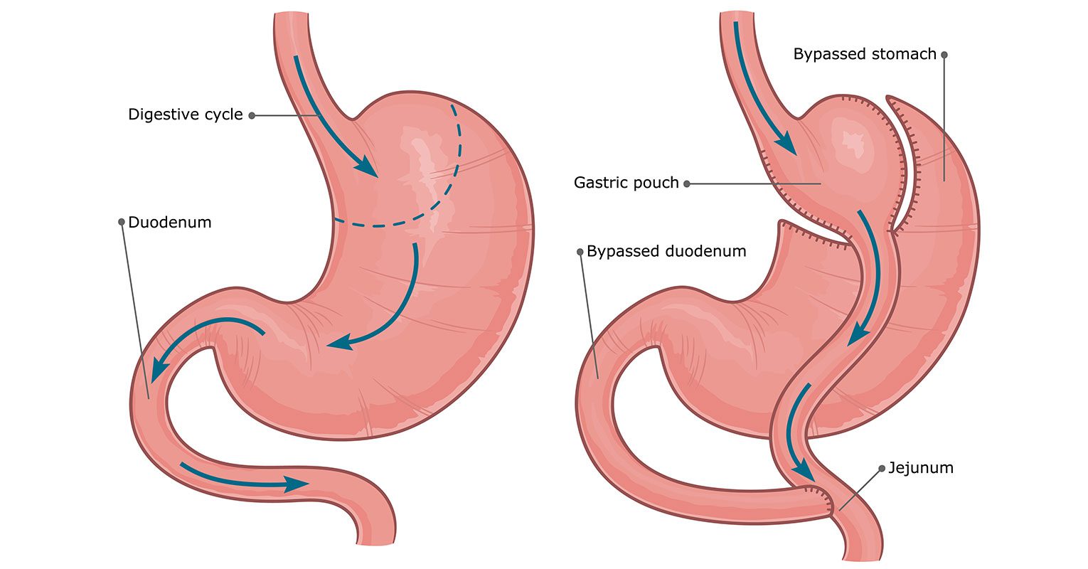 Does Cigna Cover Gastric Bypass Revision